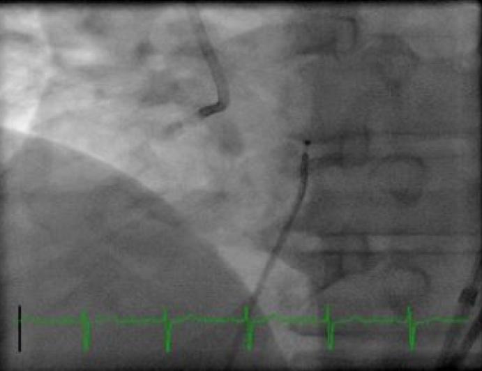 The Role of CTA in Modern Day CTO PCI — Case Examples